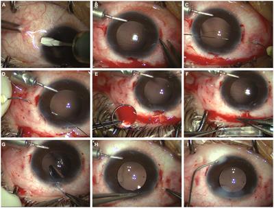 Clinical observation of a modified technique for intrascleral fixation of flanged three-piece foldable intraocular lenses through a Hoffman pocket